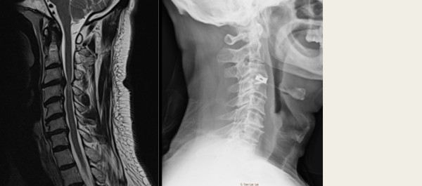 Artrodesis cervical via