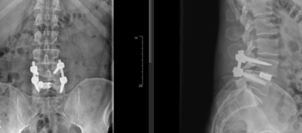 Artrodesis lumbar TLIF 2
