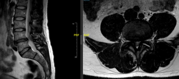 Artrodesis lumbar TLIF
