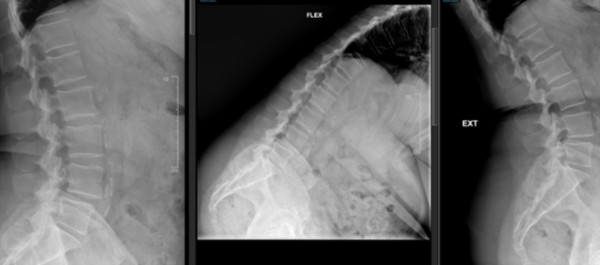 Espondilolistesis degen