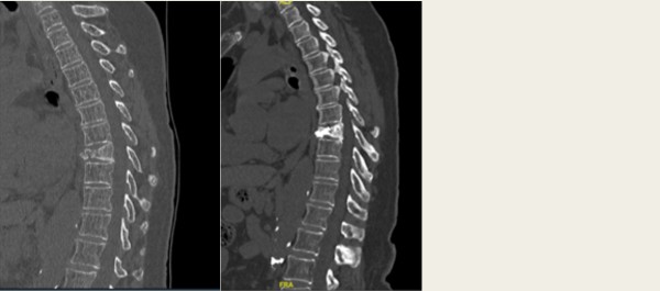 Vertebroplastia