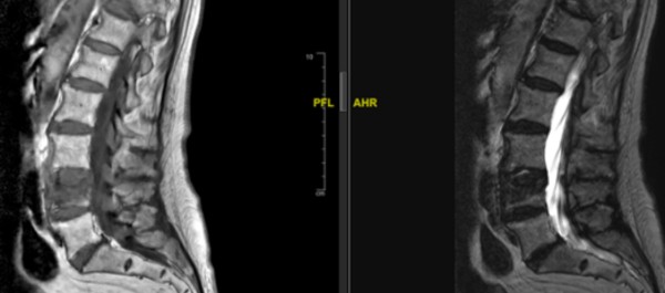 fractures verte