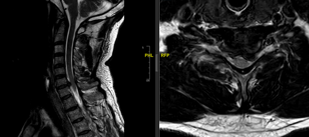 hernia discal cervical