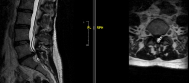 herniadiscal-lumbar